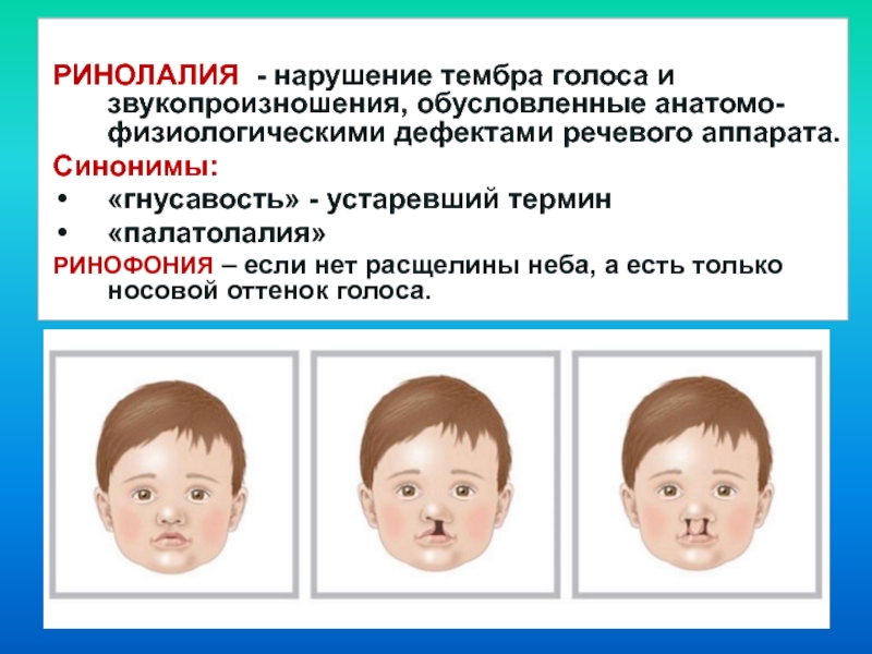 Виды расщелин при ринолалии картинки