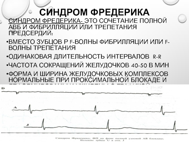 Синдром фредерика на экг фото