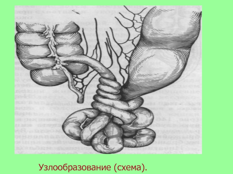 Паралитический илеус