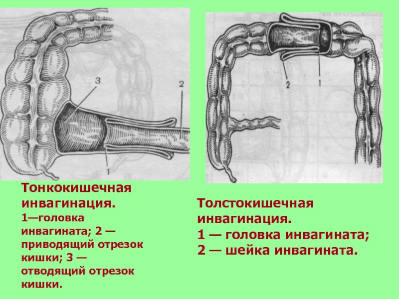 При непроходимости кишечника стул