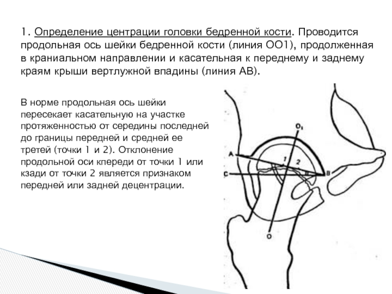 Продольная ось. Линия Моргана шейка бедренной кости. Децентрация головки бедренной кости. Головка бедренной кости децентрирована?????.