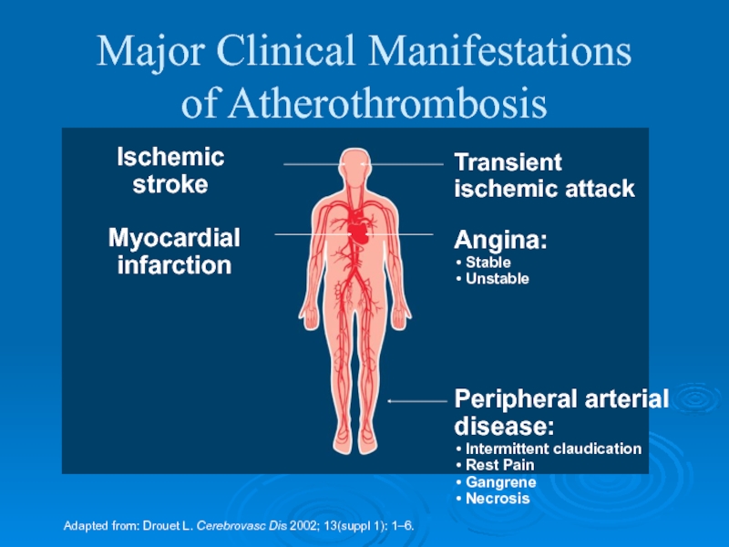 Ischemic stroke. Polioьнудшен Clinical manifestations.