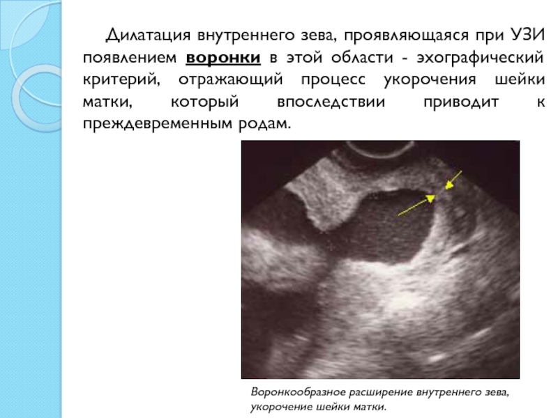 Шейка при второй беременности. Истмико-цервикальная недостаточность на УЗИ. Воронкообразное расширение внутреннего зева УЗИ. ИЦН на УЗИ внутренний зев. Раскрытие внутреннего зева УЗИ.