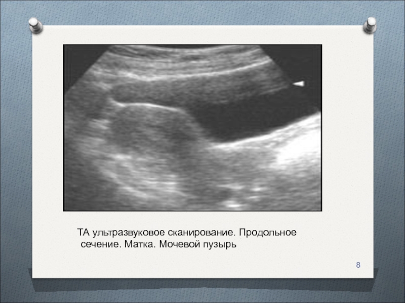 Матка мочевой. Продольное сечение. Ультразвуковая сканограмма. Продольное сечение это на УЗИ. Продольное сечение фото.