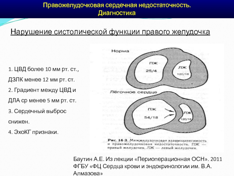 Хсн диагноз. Правожелудочковая недостаточность клиника. Клиника хронической правожелудочковой недостаточности. Синдром правожелудочковой сердечной недостаточности пропедевтика. Правожелудочковая сердечная недостаточность.