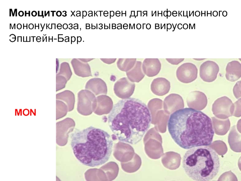 Для инфекционного мононуклеоза характерно