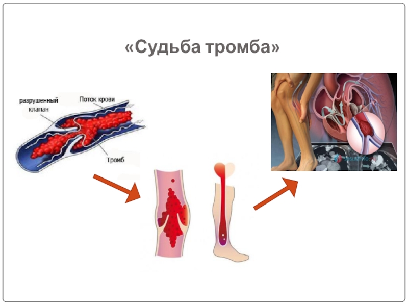 Посттромбофлебитический синдром презентация