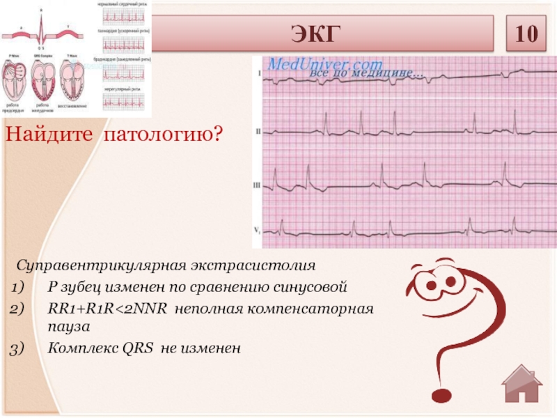 Экг рейтинг. Патология на ЭКГ экстрасистолы. ЭКГ 2 отведения экстрасистолий суправентрикулярная. R1s3 на ЭКГ. Функциональная экстрасистолия.