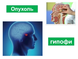 Опухоль гипофиза