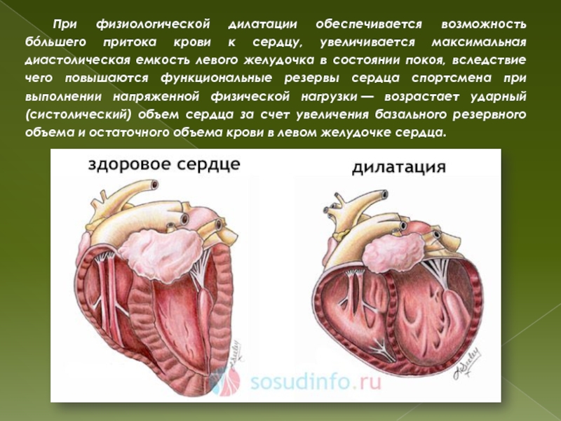 Увеличение лев желудочка