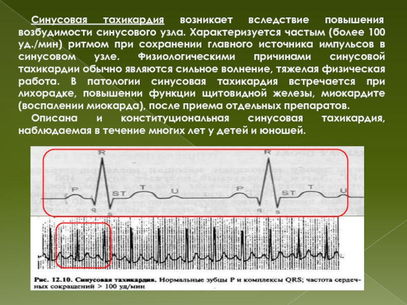 Синусовая тахикардия это