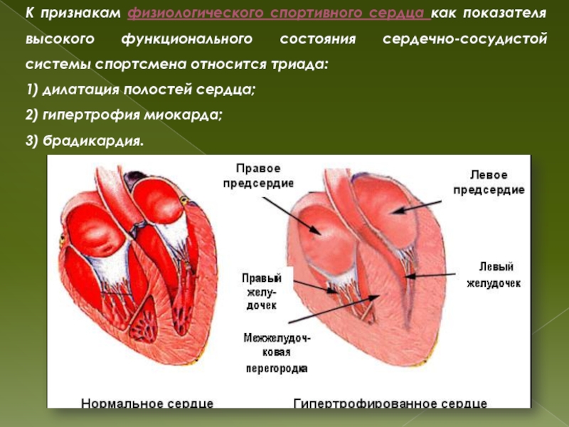 Тренированность сердца. Спортивное сердце. Спортивное сердце симптомы. Физиологическое спортивное сердце. Дилатация спортивного сердца это.