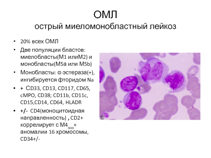 Миеломоноцитарный лейкоз картина крови