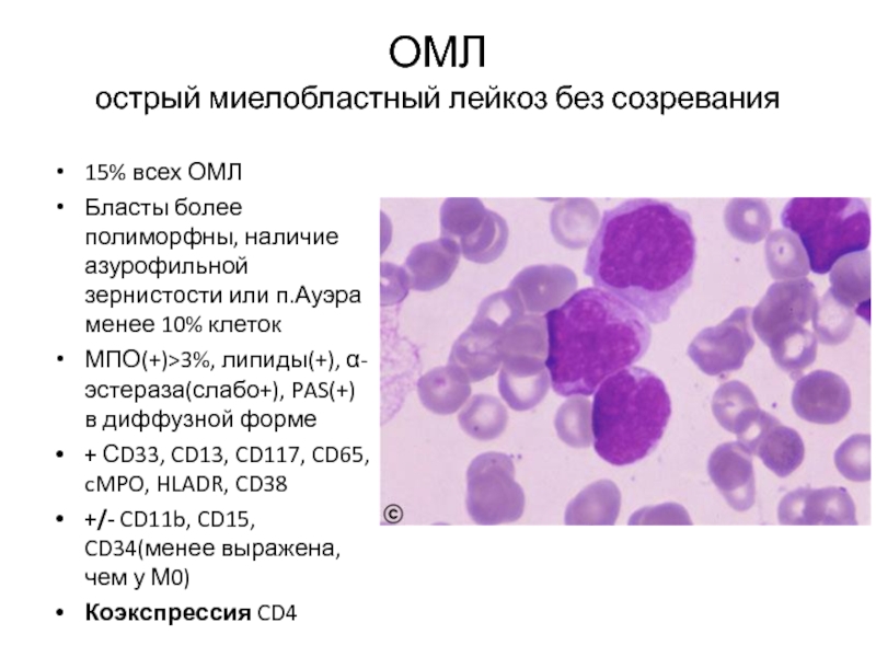 Острый миелобластный лейкоз презентация