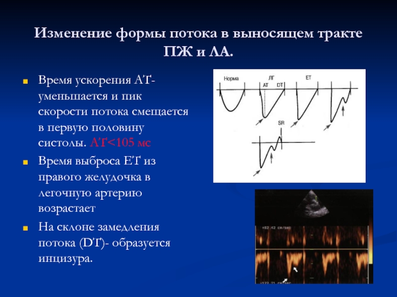 Изменение потока. Время ускорения потока в выносящем тракте правого желудочка. Норма скорости в выносящем тракте левого желудочка. Скорость кровотока в выносящем тракте правого желудочка. Время ускорения потока в выносящем тракте.