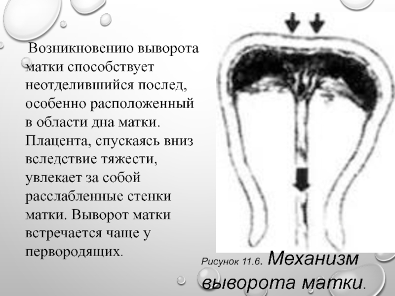 Ощущение матки. Основное условие, способствующее вывороту матки.