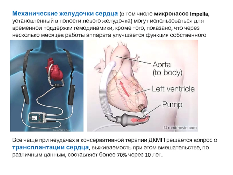 Сколько весит искусственный левый желудочек для сердца. Механические желудочки сердца. Искусственный желудочек сердца. Искусственный левый желудочек сердца. Механический левый желудочек сердца.