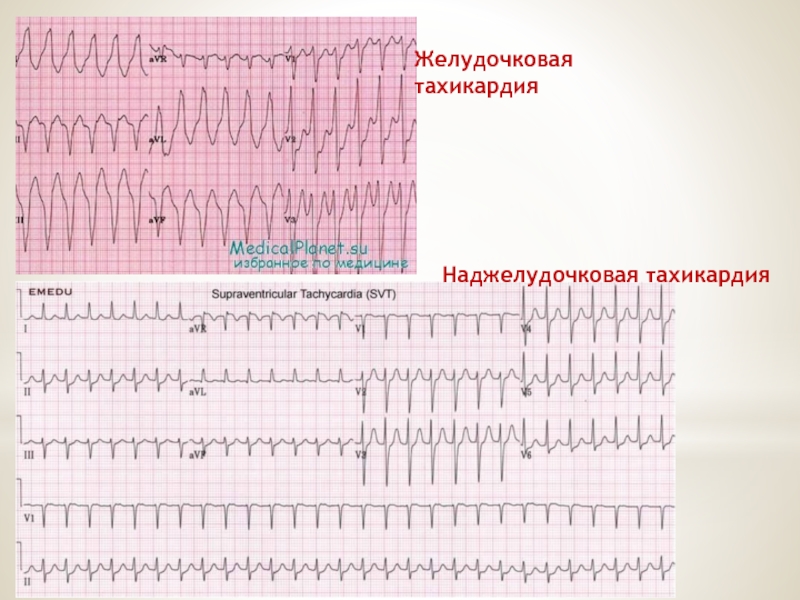 Пароксизмальная наджелудочковая тахикардия. Пароксизмальная суправентрикулярная тахикардия желудочковая ЭКГ. Наджелудочковая форма пароксизмальной тахикардии ЭКГ. ЭКГ при пароксизмальной наджелудочковой тахикардии. Наджелудочковая и желудочковая тахикардия на ЭКГ.