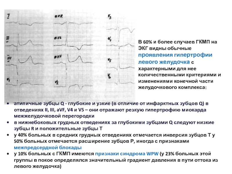 Экг при дилатационной кардиомиопатии фото