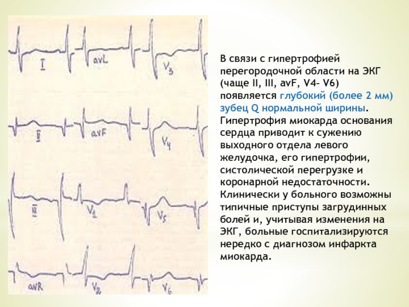 Как часто экг. Глубокие q в III AVF на ЭКГ. Зубец q II III AVF. Глубокий зубец s на ЭКГ на v2 v3. Глубокий q на AVF ЭКГ.