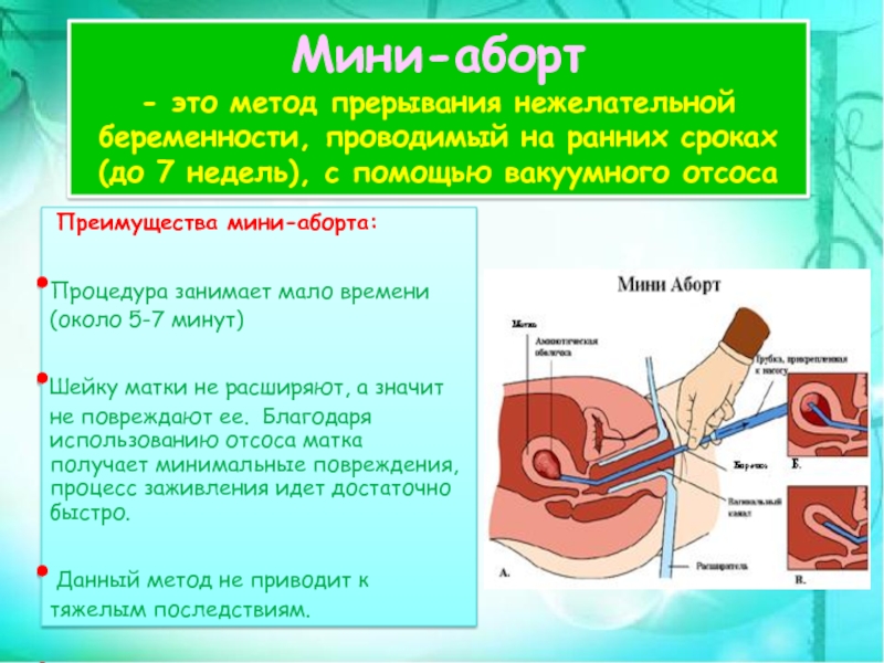 Вакуум оборот. Вакуумный аборт на ранних.сроках. Вакуумный аборт (мини-аборт). До какого срока делается вакуумный аборт. Вакуумный метод прерывания беременности.