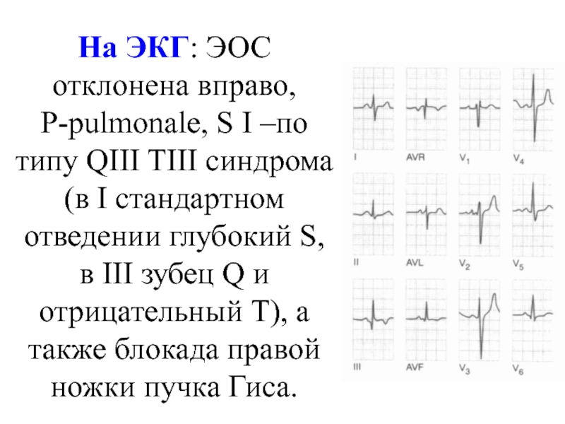 Эос экг. Отрицательный р в 3 отведении на ЭКГ. Отрицательный зубец q в 3 отведении на ЭКГ. Зубец q в 3 отведении на ЭКГ позиционный. Отрицательный зубец r на ЭКГ В 3 отведении.