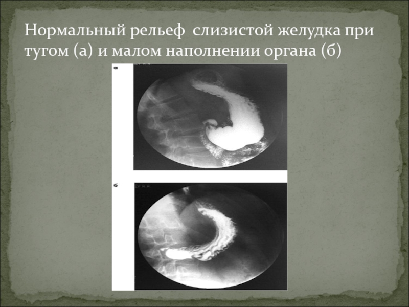 Рельеф слизистой желудка. Желудок при тугом наполнение. Рельеф характерный для слизистой желудка.