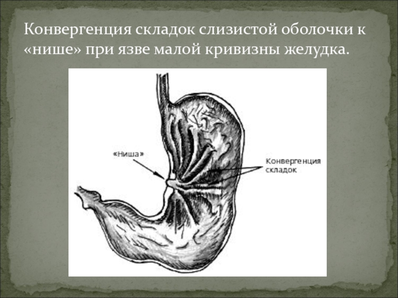 Складки слизистой. Малая кривизна желудка. Малай кривизна желудка. Конвергенция складок слизистой. Язва большой кривизны желудка.