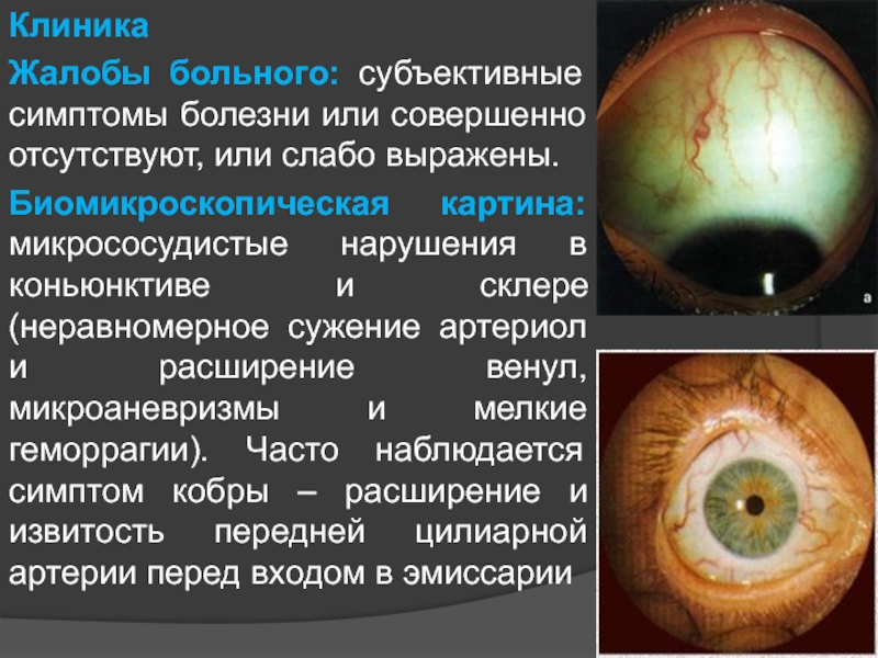 Глаукома латынь. Презентация на тему глаукома. Симптом кобры глаукома. Признаки открытоугольной глаукомы. Микрососудистые аномалии.
