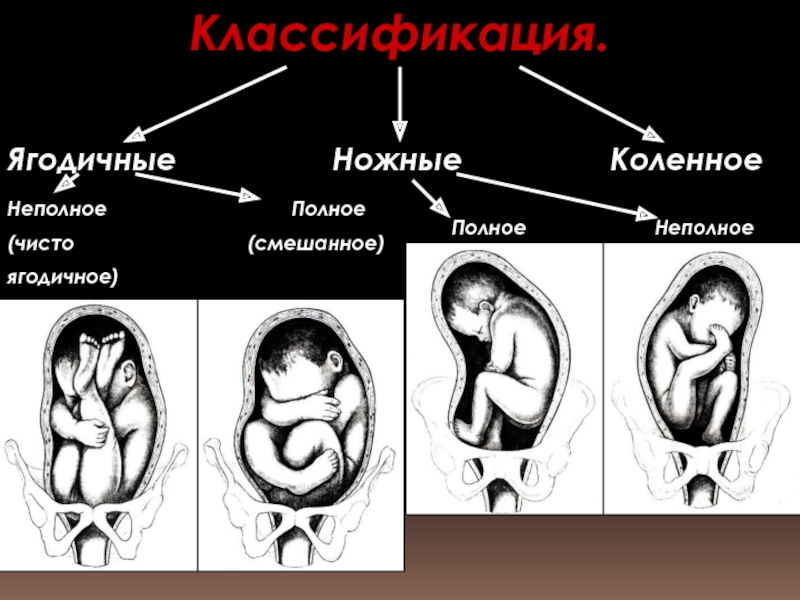 Ножное предлежание плода