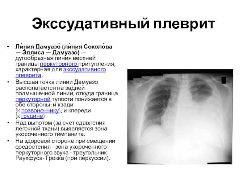 Экссудативный плеврит карта вызова