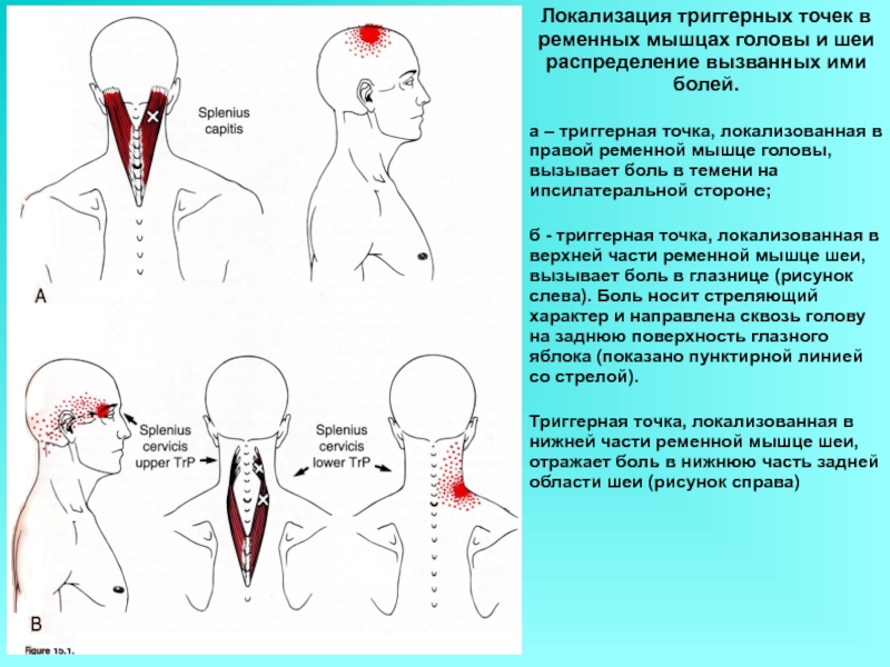 Триггерные точки схема