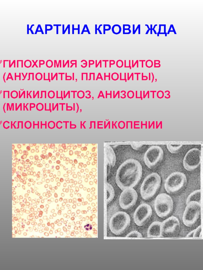 Гипохромия железодефицитная анемия. Анизоцитоз пойкилоцитоз гипохромия.  Гипохромия  микроциты  анизоцитоз  пойкилоцитоз. Железодефицитная анемия анизоцитоз. Гипохромия жда.
