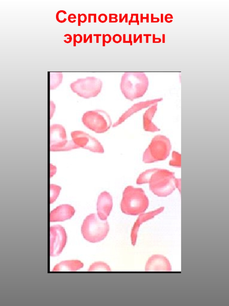 Эритроциты при серповидно клеточной анемии. Серповидноклеточная анемия эритроциты. Эритроциты при серповидноклеточной анемии. Патологические включения в эритроцитах. Серповидная анемия картина крови.