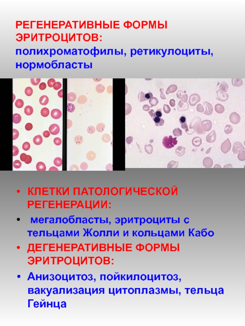 Форма эритроцитов. Патологические формы эритроцитов регенеративные. Анизоцитоз пойкилоцитоз гипохромия. Ретикулоциты и полихроматофилы. Полихроматофилы и нормобласты.