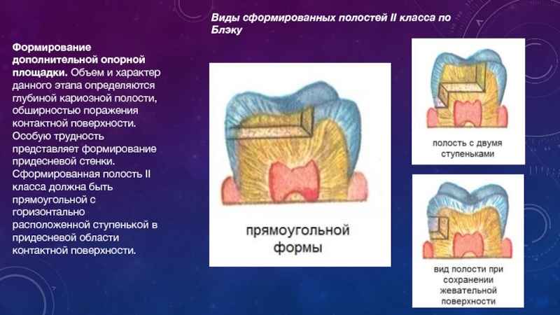 Этапы препарирования кариозных полостей. Элементы сформированной кариозной полости. Стенки кариозной полости 1 класса. Формирование стенки кариозной полости. Доп площадка кариозной полости.