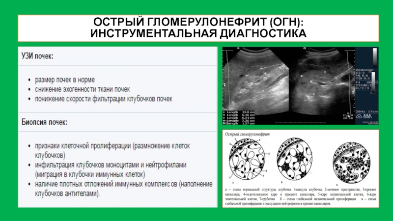 Гломерулонефрит на узи фото