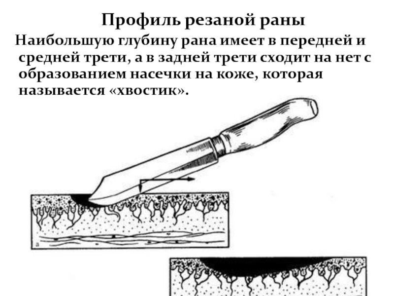 Резаная рана кисти карта вызова смп