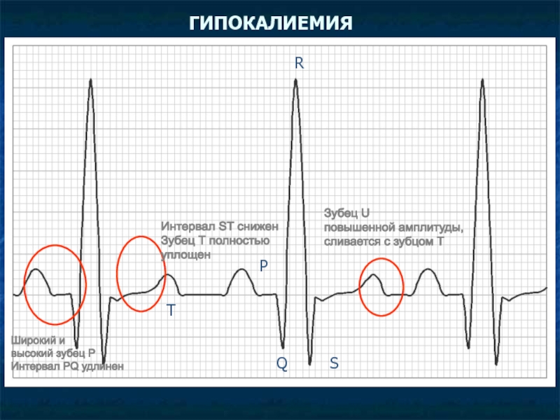 Увеличение амплитуды зубцов