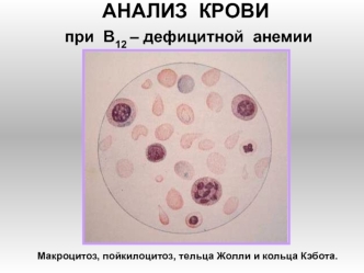 Анализ крови при В12-дефицитной анемии. Макроцитоз, пойкилоцитоз, тельца Жолли и кольца Кэбота