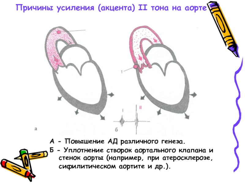 Что означает уплотнения аорты