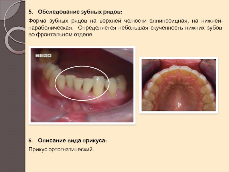 Реферат: История болезни - Стоматология (Перелом нижней челюсти в области 8)