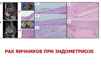 Рак яичников при эндометриозе