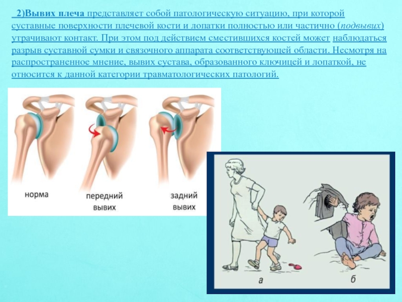 Первичный вывих плечевого сустава карта вызова