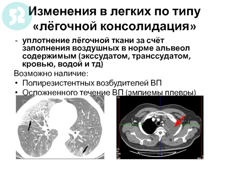 Что такое консолидация. Консолидация пневмония кт. Консолидация в легких. Консолидация легочной ткани. Консолидация на кт легких.