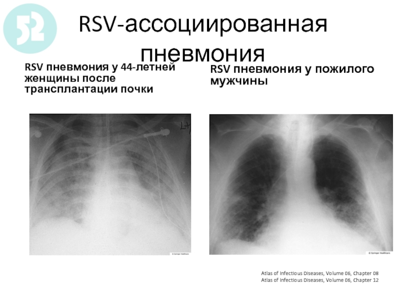 Двухсторонняя пневмония у взрослого. Крупнофокусная пневмония. Двухсторонняя пневмония.