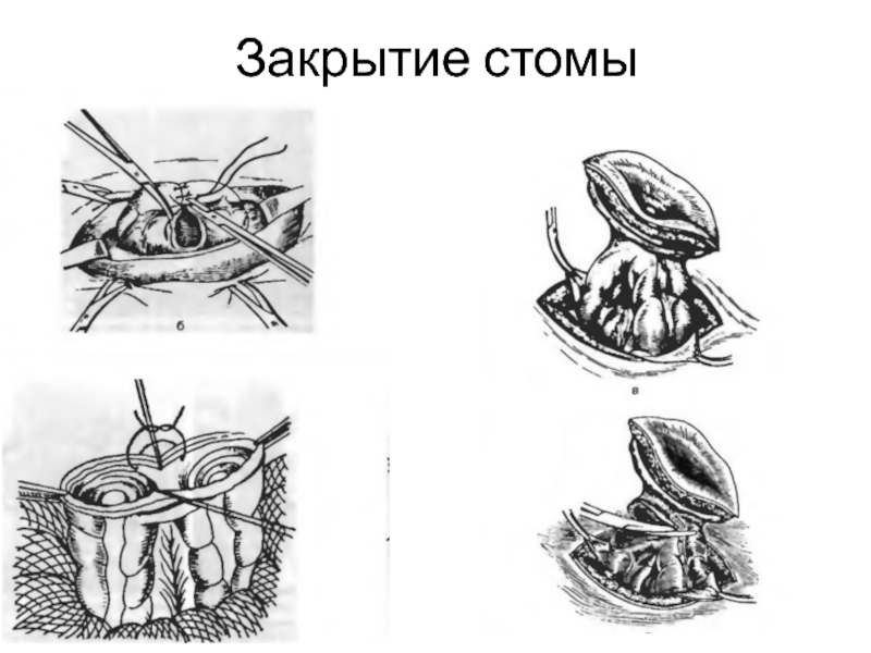 Закрытие стомы отзывы пациентов