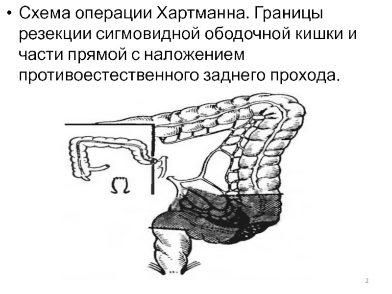 Схема операция гартмана