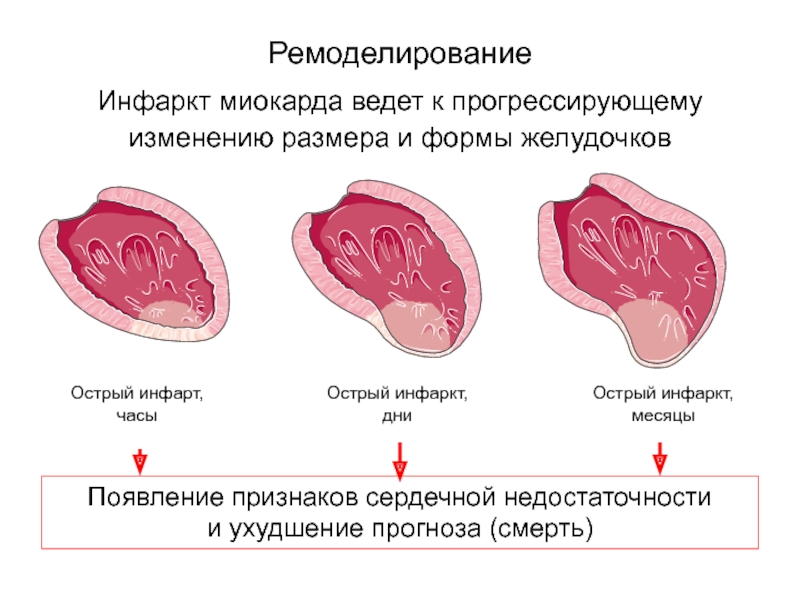 Осложнения инфаркта миокарда презентация