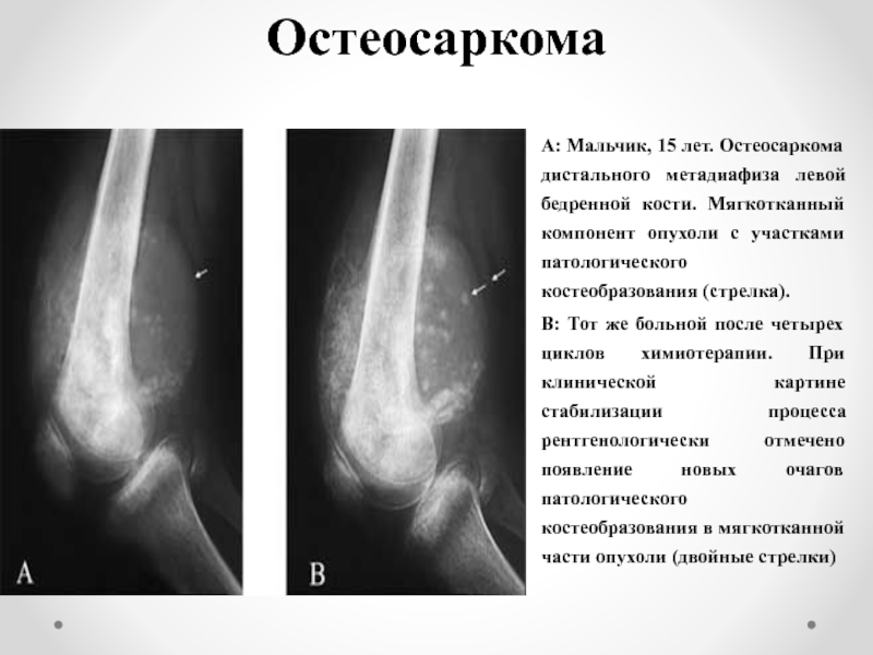 Опухоли костей схема